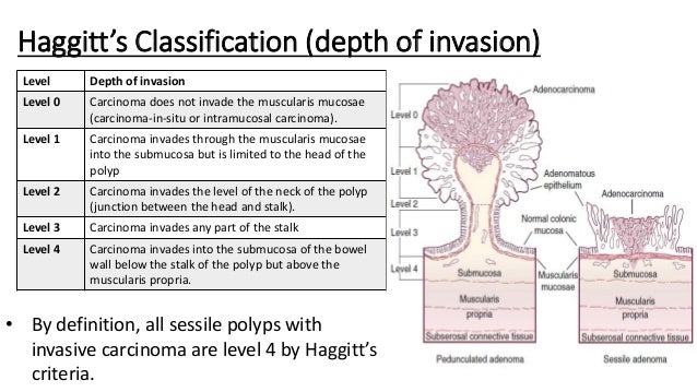 haggitt classification of polyps